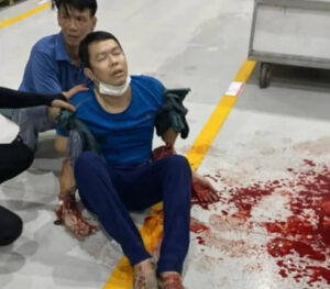 Worker forgets his hands in hydraulic machine