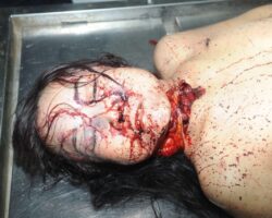 Chinese woman with deep wound on her neck