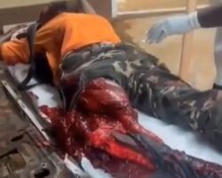 Destroyed leg from traffic accident