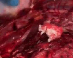 Examination of broken spine on dead woman