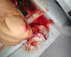 Italian tourist seriously injured by boat propeller in Colombia