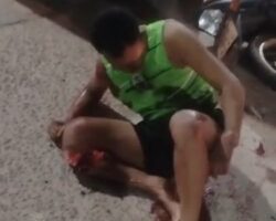 Mangled leg from motorcycle accident