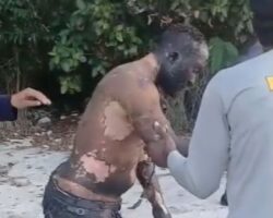 Bus driver suffered third-degree burns