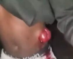 Guy walks with exposed guts from stab wound