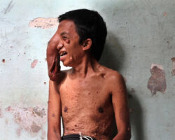 Indonesian man battling with massive tumor on his eye