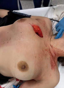 Knife fight between two prostitutes ends in chest ripped open