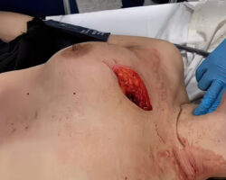 Knife fight between two prostitutes ends in chest ripped open