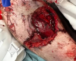 Legs destroyed in traffic accident