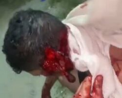 Slash wounds from machete fight