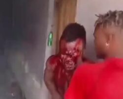 Stabbed in eye by his girlfriend