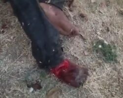 Traumatic amputation at ankle level as result of motorcycle accident