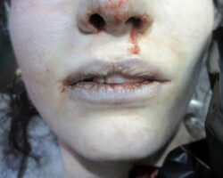 Young woman committed suicide using sodium nitrate and sodium nitrite