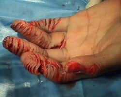 All fingers destroyed by paper shredder