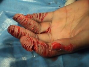 All fingers destroyed by paper shredder