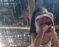 Child with cystic hygroma