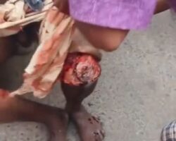 Collision with truck peeled the skin off his knee