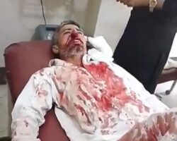 Damaged nose caused by traffic accident