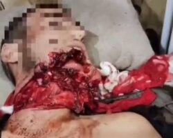 Explosion tore apart Russian soldier’s face