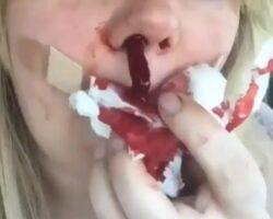 Huge blood clot removed from nose
