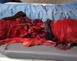 Indian man suffered traumatic amputation of lower limb