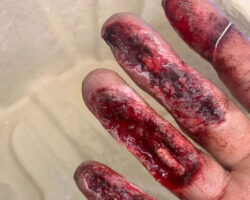 Painful hand injury caused by careless handling of angle grinder