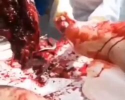 Soldier’s leg torn off by explosion