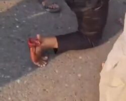 Ugly foot injury during political fight