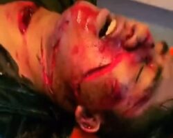 Facial injury caused by machete