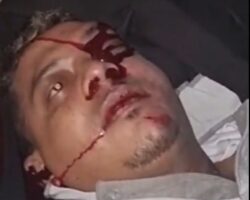 Gasping for breath after motorcycle accident