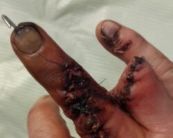 Man lost his fingers in work accident