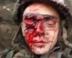 Russian soldier lost eye during fighting in Ukraine