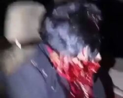 Shot in face with shotgun