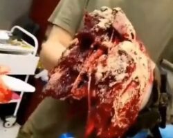 Treatment of Russian soldier with amputated lower limb