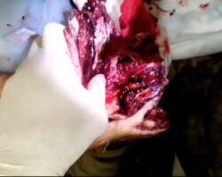 Treatment of traumatic amputation without anesthesia