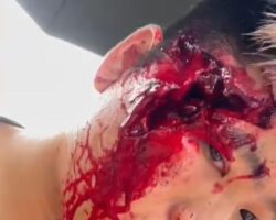 Chinese motorcyclist has hole in his head after crash