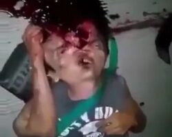 Earthquake victim with split-open head