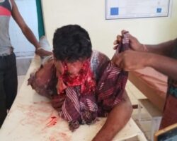 Face severely disfigured after bear attack