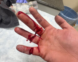 Hand cut with knife
