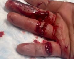 Hand cut with knife
