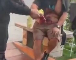 Man lost his right hand after explosion