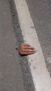 Motorcyclist lost his hand in crash