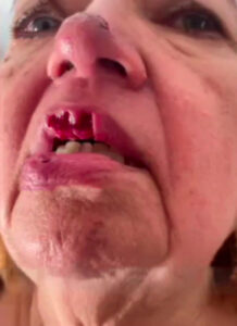 Pit bull gave bloody bite