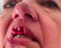 Pit bull gave bloody bite