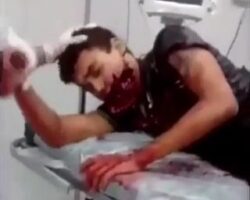 Torn-off jaw in traffic incident
