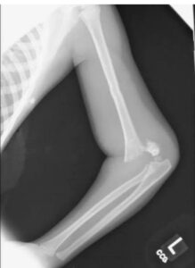 Boy breaks arm during failed skate attempt