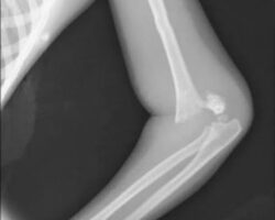 Boy breaks arm during failed skate attempt