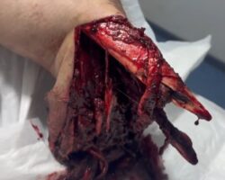 Explosion caused him traumatic amputation of lower limbs