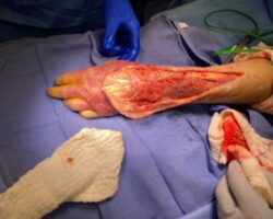 MIX: Necrotizing fasciitis