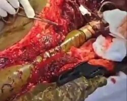 RPG projectile lodged in Ukrainian soldier’s body