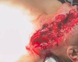 Russian soldier seriously wounded by shrapnel